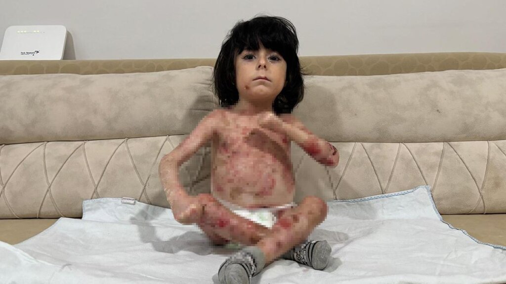 İbrahim’in Dramı: Minik Bedeni Kıyafet Bile Taşıyamıyor!